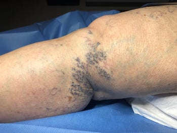 Are-varicose-veins-and-prominent-veins-the-same