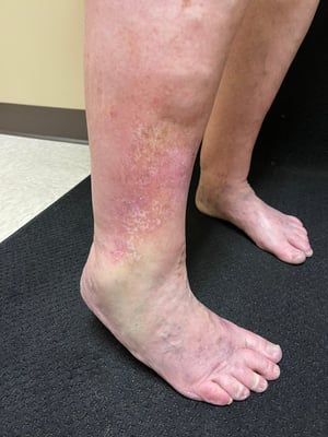 Venous dermatitis seen at a vein screening at Missouri Vein Care