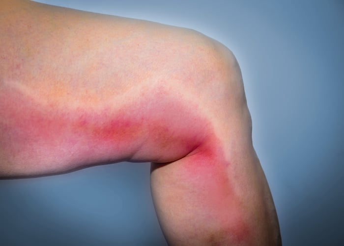 Is phlebitis a dangerous condition?