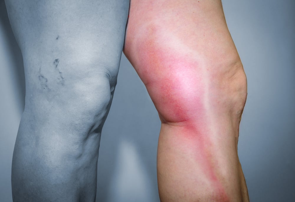 MVC - phlebitis 1