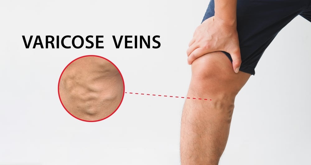 MVC - varicose veins