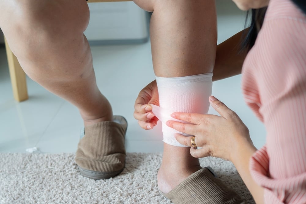 Missouri Vein Care - bleeding varicose veins or spider veins