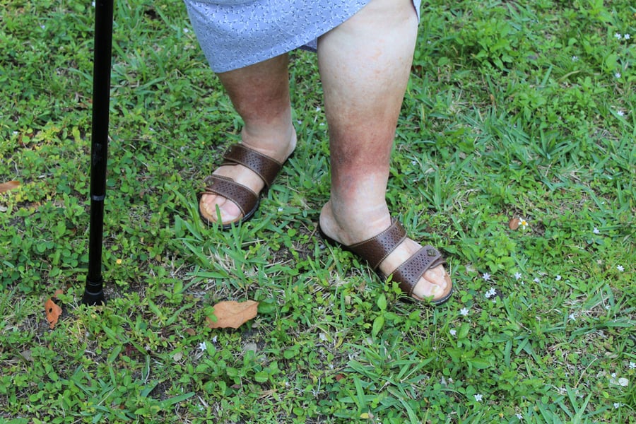 Mo Vein Care - skin discoloration