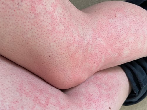 Mottled Skin - MVC