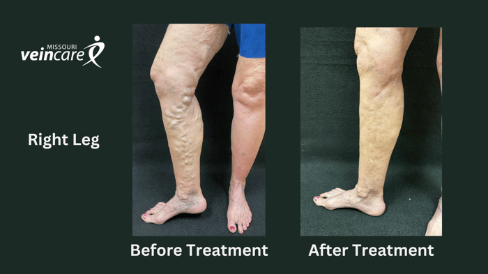 Right Leg Before_After