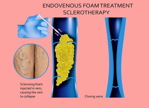 Sclerotherapy infographic
