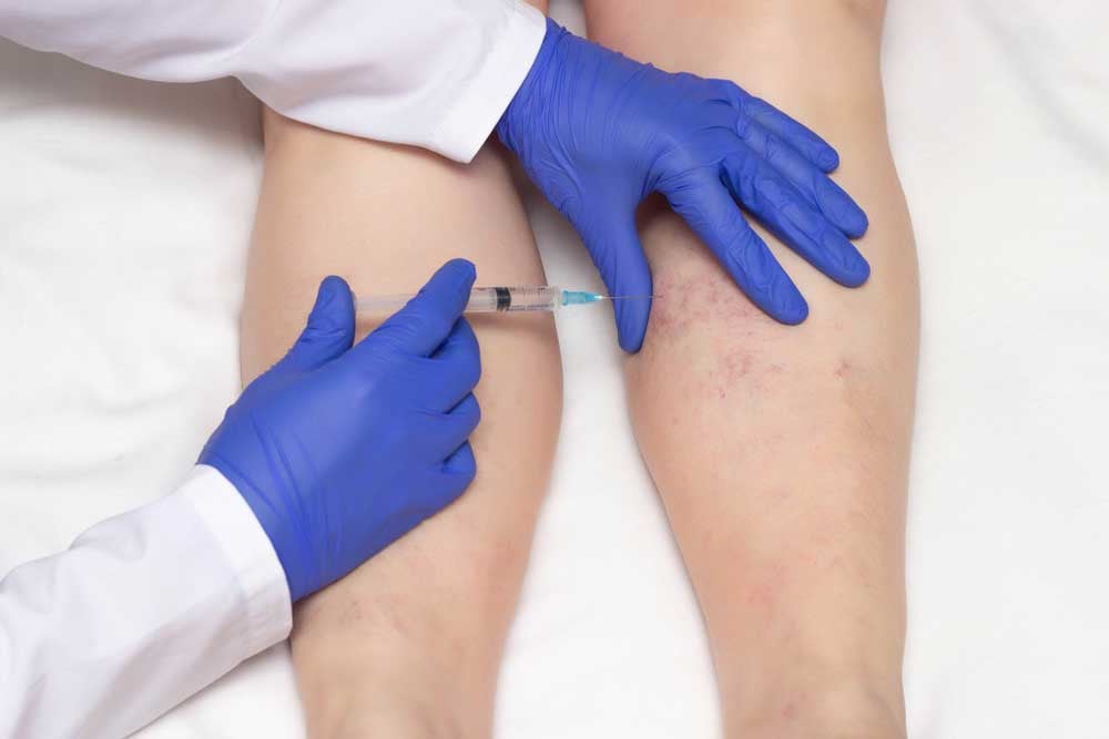 Sclerotherapy-what-is-it-and-how-it-works