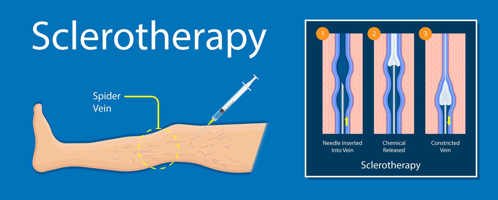 Sclerotherapy What Is It And How Does It Work 4216