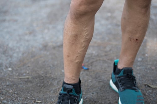 Signs-of-a-vein-condition-in-an-athlete