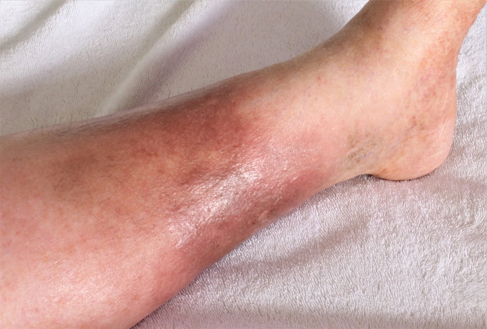 What Causes Red Blotches On Top Of Feet