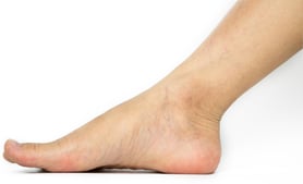 What is the Significance of Spider Veins Around My Ankles