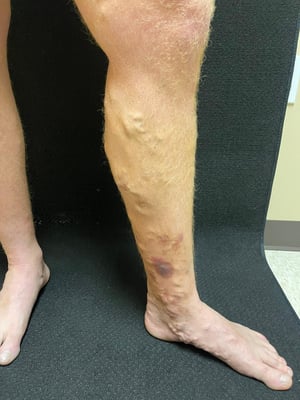 Venous eczema seen at a venous ultrasound at Missouri Vein Care