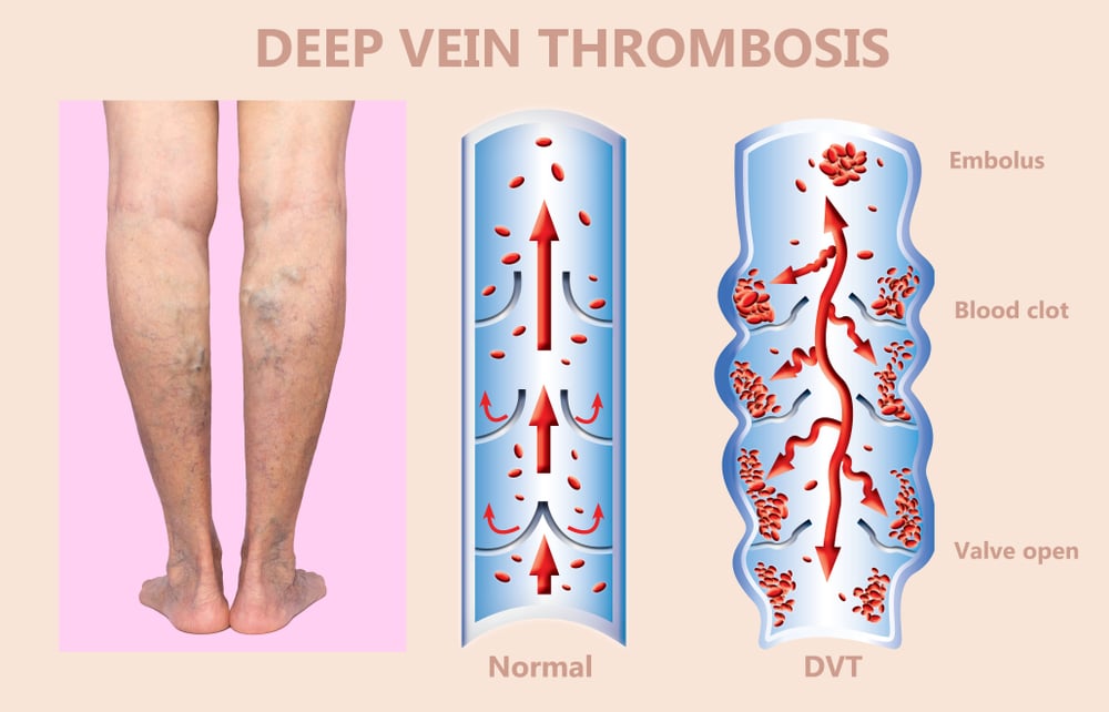 What Happens After a Deep Vein Thrombosis