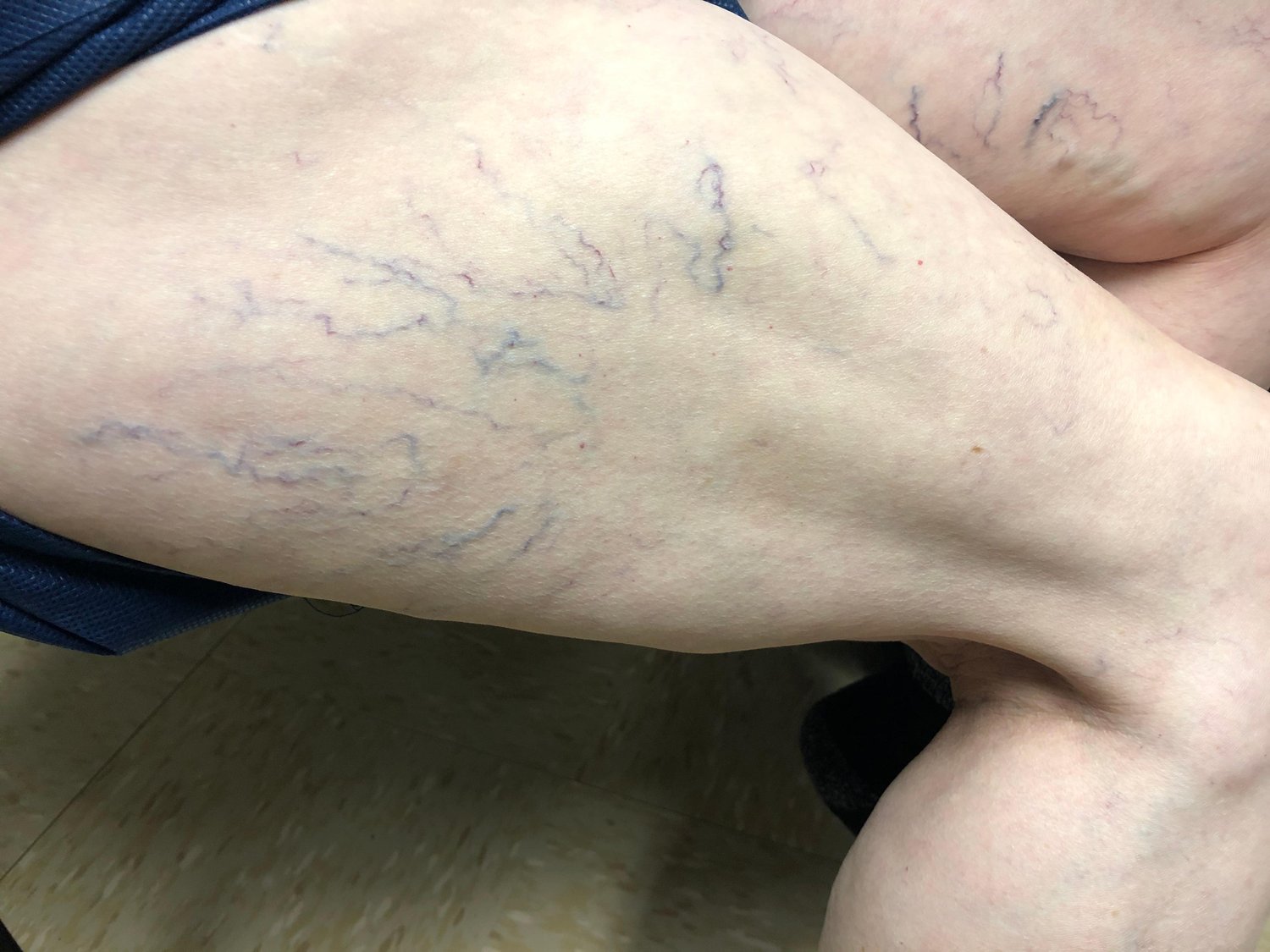 harvard-trained-vein-doctors-can-venous-insufficiency-be-cured-leg