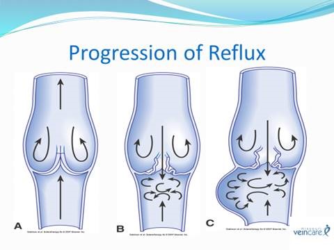 progression-of-vein-reflux