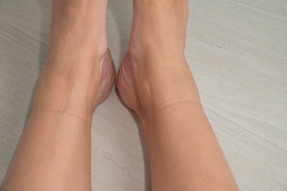 sock lines on ankles Missouri Vein Care
