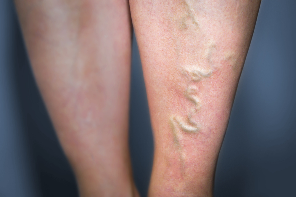 varicose veins