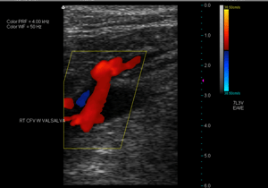 vein-reflux-leaky-valve-syndrome-red