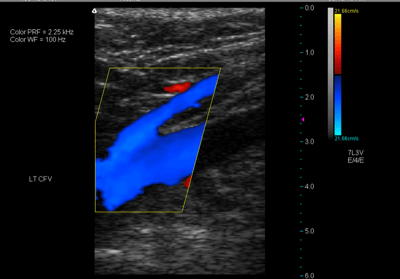vein-reflux-ultrasound-healthy-blue