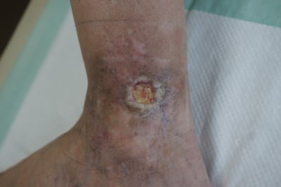 venous-leg-ulcer